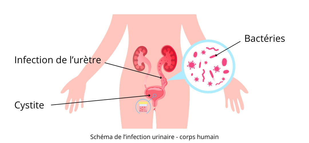 Schéma de l'infection urinaire du corps humain